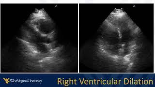 POCUS in Acute Dyspnea 2 - Heart and Lung Review