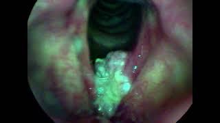 Laryngeal Cancer Causing Hoarse Voice