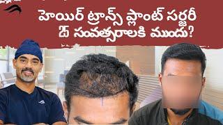 Hair Transplant In Hyderabad | Best Results Surgeon & Cost  Of Hair Transplant Surgery In Hyderabad
