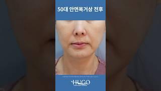 안면거상 + 목거상 1개월 차 전후 | 10년은 어려 보이게 변신! 이 정도면 다른 사람?! 