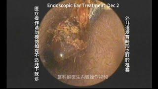 Embolization of earwax in the development of abnormal external auditory canal 20241202