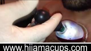 Hijama Lesson 4 الحجامه  Part 2 2 Cupping the Chest