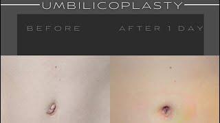 Umbilicoplasty, bellybutton turned innie! #youtubeshorts #umbilicoplasty