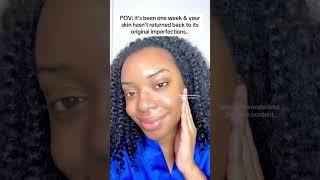  this soap erased my acne and discoloration so FAST!! | Whippedwonderlandskincare #glassskin