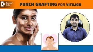 PUNCH GRAFTING- Vitiligo Treatment | Vitiligo Surgery Step by Step-Dr.Rajdeep Mysore|Doctors' Circle