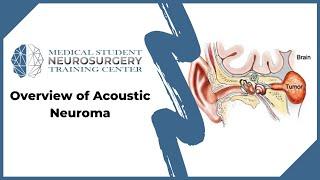 Overview of Acoustic Neuroma