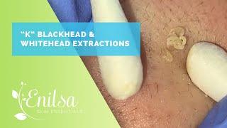 Blackhead & Whitehead Extractions on "K" Part 3