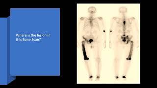 Abnormal Bone scan