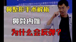 【鼻整形】鼻骨的截骨内推有哪些方式？为什么有些人做完之后会反弹没效果？