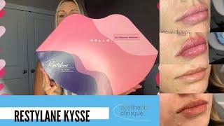 Restylane Kysse - The NEW Lip Filler Explained By PA Brittany Of The Aesthetic Clinique