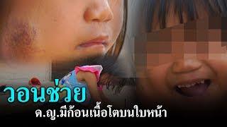 วอนช่วยด.ญ.มีก้อนเนื้อโตบนใบหน้า | ข่าวช่องวัน | one31