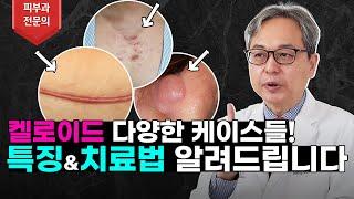 켈로이드의 다양한 케이스들! 각각에 맞는 특징과 치료법 알려드리겠습니다! #켈로이드