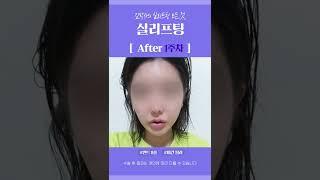 #shorts 실리프팅으로 안티에이징 동안의 세계로