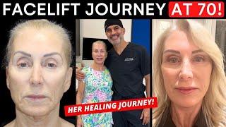 Facelift Transformation at 70: Before & After the Entire Healing Journey!