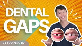 Dental Gap Filling with Dr. Soo: What Are Your Best Options?