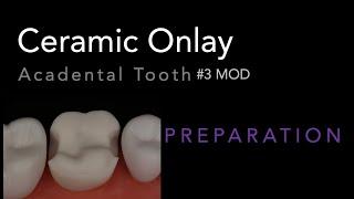 MOD Ceramic Onlay #3 Acadental | Dr. Richard Stevenson