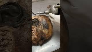 Cadaveric Dissection of skull : For teaching Anatomy