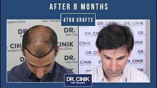 Dr. Cinik Hair Transplant Clinic / 4700 GRAFTS ( 2 Sessions) | Hair Transplant | Dr. Emrah Cinik