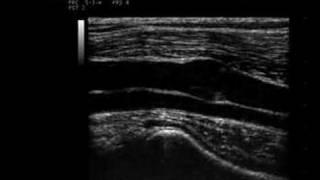 Phlebology Biosound Esaote MyLab 25 Venous Duplex