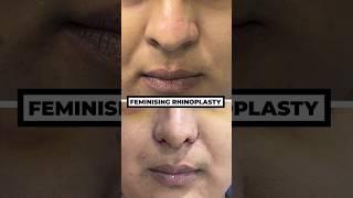 Feminising Rhinoplasty vs Regular Rhinoplasty | Rhinoplasty Surgery in Mumbai | Dr. Parag Telang