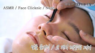 I cleaned the face of ASMR nasal sebum removal. Black Head Removal