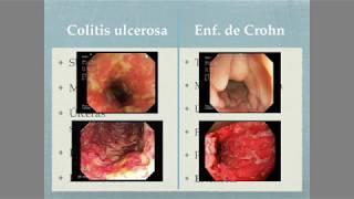 Colitis ulcerosa Vs. Enfermedad de Crohn