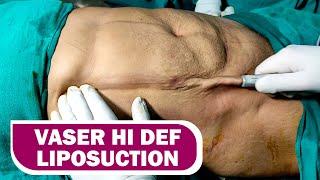 360° Abdomen Liposuction & Back Liposuction. VASER Hi Def Lipo #dezireclinic