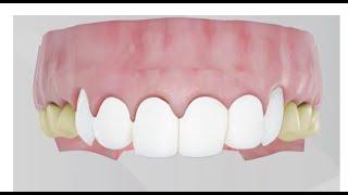 Dental Veneers