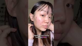 How I knew my acne was Hormonal  #acne #hormonalacne #acnejourney #viral