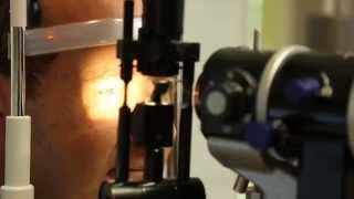 SMILE Laser Eye Surgery