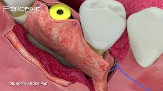 Soft Tissue Managment at the time of Implant Placement