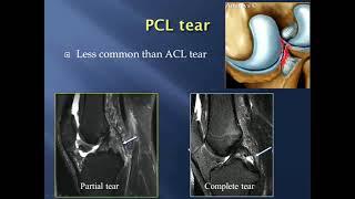 New updates : Imaging of knee ligaments