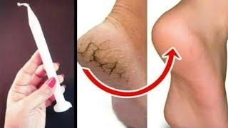 The final solution to get rid of the cracks of the feet with one candle in one day