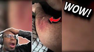 He Needs a Doctor NOW! | Pimple Popping and Blackhead Popping Compilation