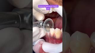 IPR BRACES, Orthodontics Treatment