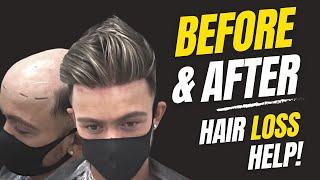 Before & After | Hair System | Non-Surgical Hair Replacement System Men/Women | UK/USA/International