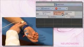 Motoric Neurography - Median Nerve