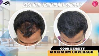 Hair Transplant In Coimbatore | Best Cost Results  Surgeon & Clinic Of Hair Transplant in Coimbatore