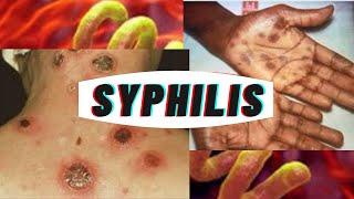 What is Syphilis | Stages of syphilis infection | causes of syphilis | symptoms of syphilis