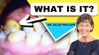 What is Dental Plaque? (How to Prevent More From Forming)