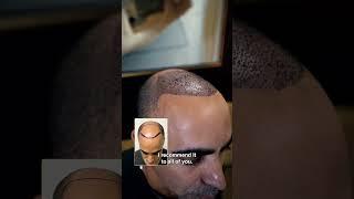 First Week After a Hair Transplant | Care4Hair Miami