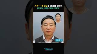 안면목거상+피치거상+상·하안검 수술 전후 공개! 이 얼굴이 60대?!