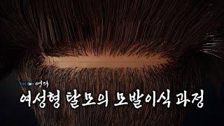 [명의 의학백과] 여성형 탈모의 모발이식 과정