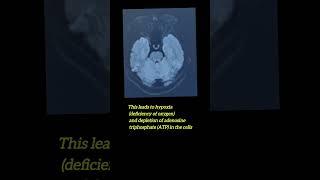Acute Brain Infarct