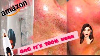 Black head remover device from Amazon | black head vacuum  work️ or not