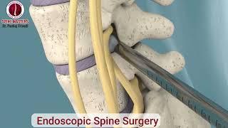 Bihar Patient | Life after Endoscopic Spine Surgery | Without any scar |  7 mm cut | No anesthesia