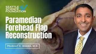 Paramedian Forehead Flap Reconstruction - Prabhat K. Bhama, M.D.