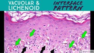 Vacuolar vs Lichenoid Interface Dermatitis Pattern - Inflammatory Dermpath Basics