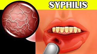 Syphilis - Causes, Signs & Symptoms, Pathogenesis, Diagnosis, And Treatment