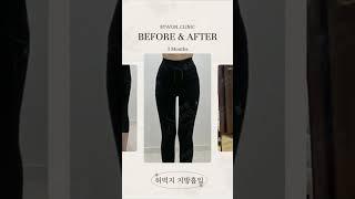 허벅지 지방흡입 후기 #허벅지지방흡입